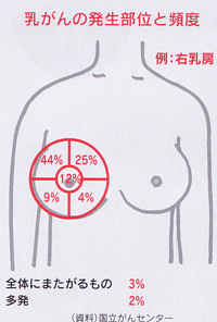 乳がんの発生部位と頻度